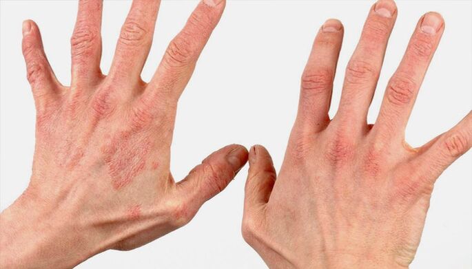 métodos de tratamento da psoríase con remedios populares
