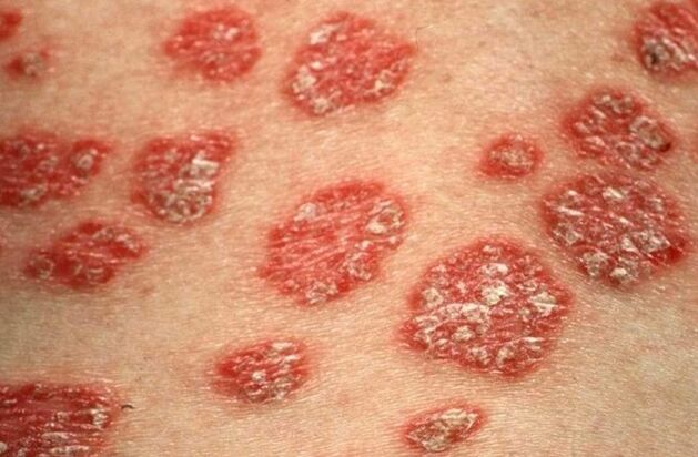 Pápulas psoriáticas