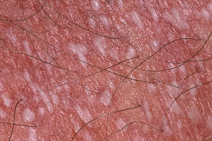 Psoríase pustulosa