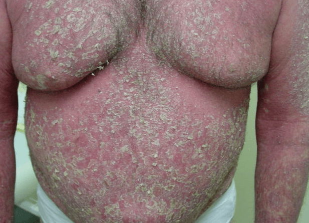 Eritrodermia psoriásica no corpo