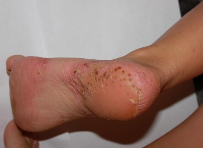 Psoríase palmoplantar