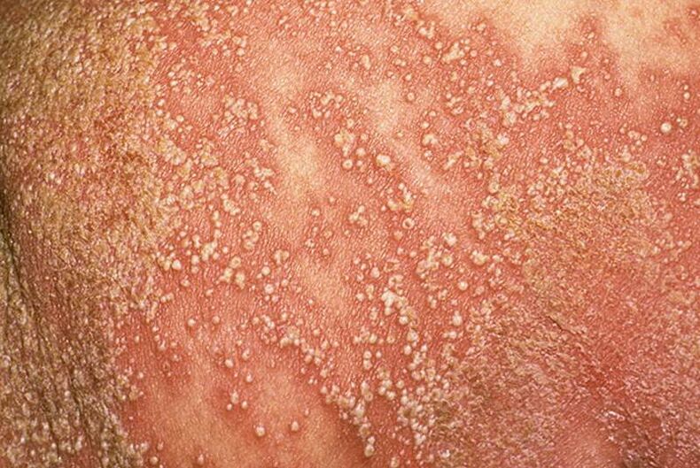 Psoríase pustulosa