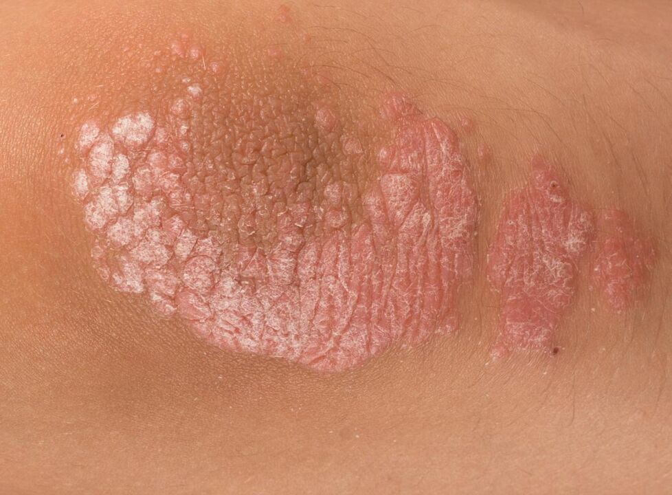 Psoríase